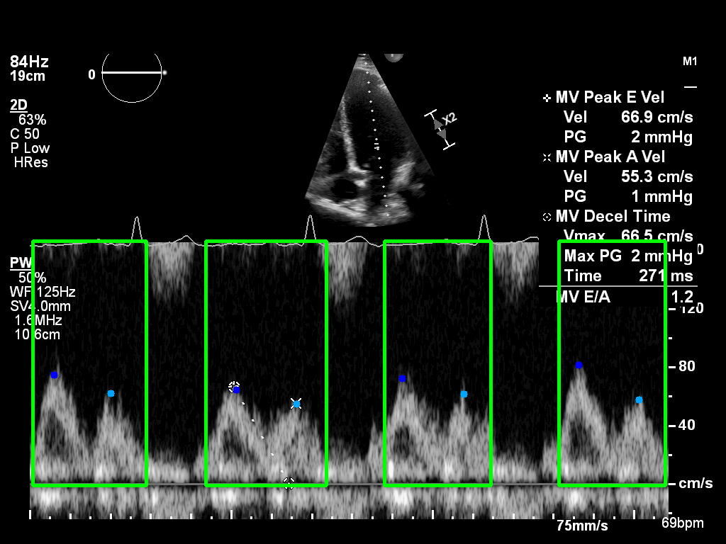 Mitral inflow example