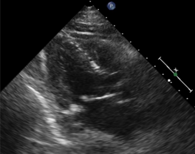 Most Foreshortened Example