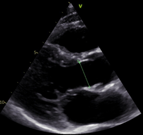 Least Foreshortened Example