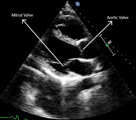 PLAX Valve Visibility Example
