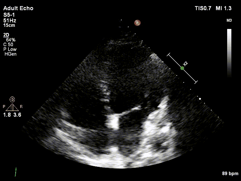 Echocardiogram Example