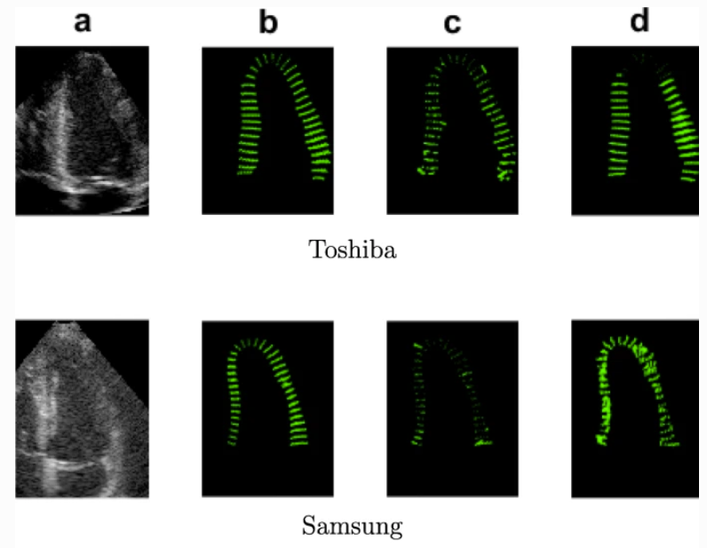 Echocardiogram Example
